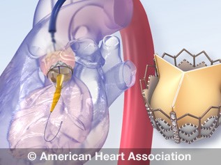 TAVR animation