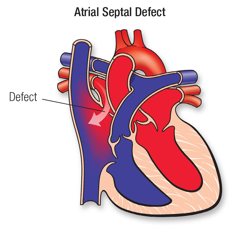 Atrial Septal Defect (ASD) | EmPOWERED To Serve